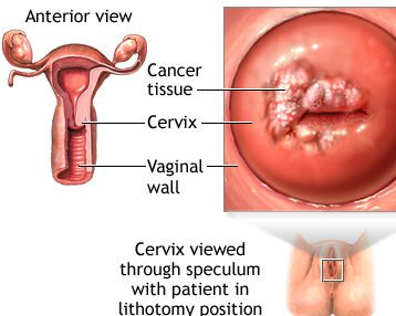 Hpv Vaccine india